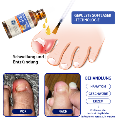 🐝🐝Furzero™ Bienengift Nagelpilz Behandlungslösung