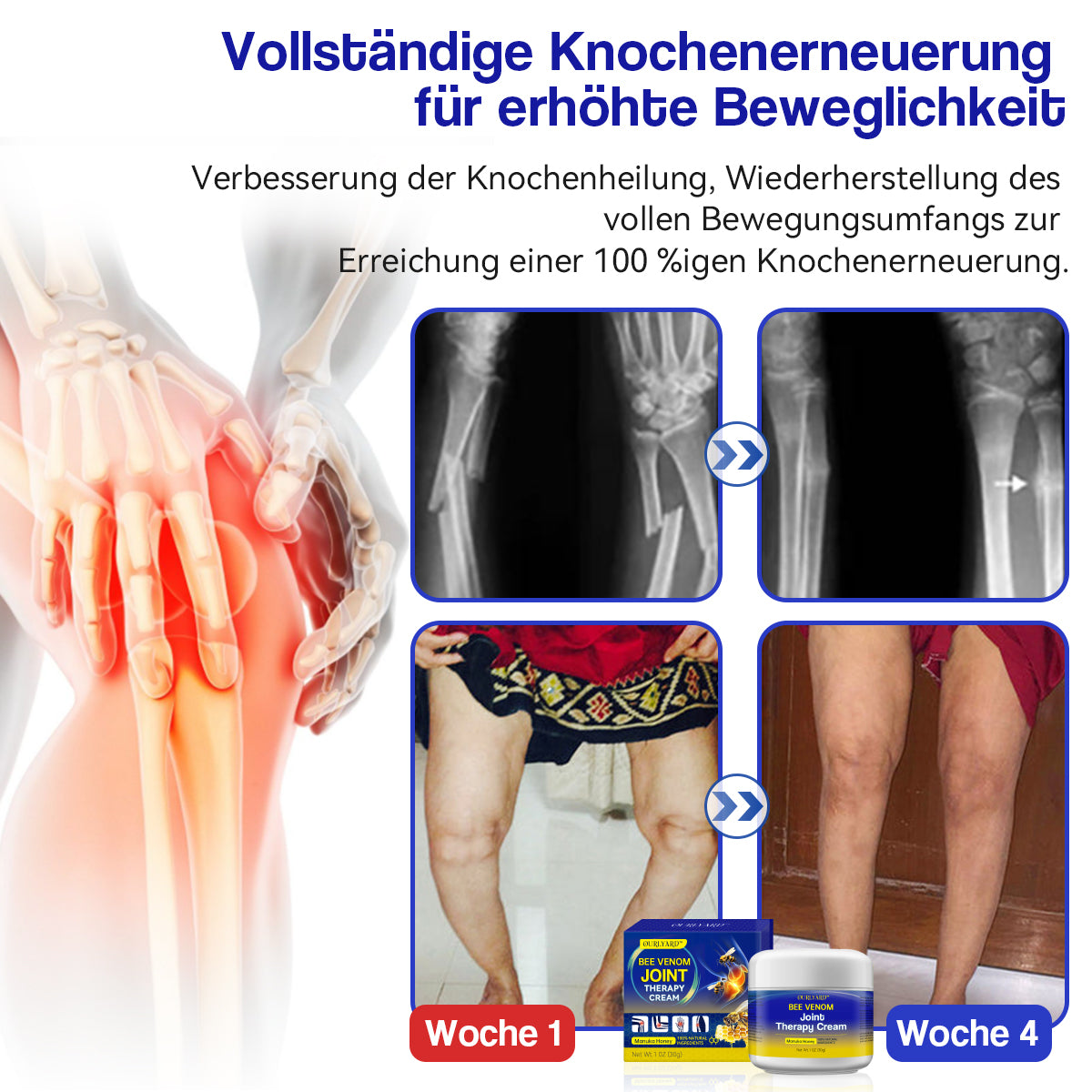 🐝🐝Ourlyard™ Bienengift-Gelenktherapie Creme: Schmerzfreie Lösung für Arthritis und knochenbedingte Probleme🌟🌟