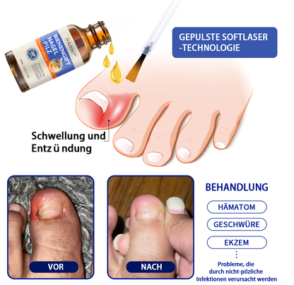 🐝🐝Furzero™ Bienengift Nagelpilz Behandlungslösung:Das Nagelpilzproblem vollständig lösen🌟👣