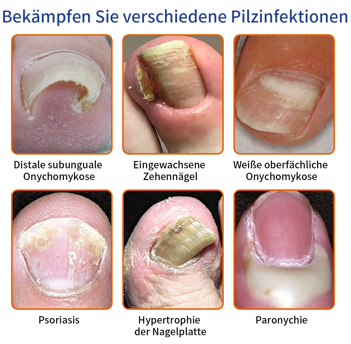 🐝🐝Furzero™ Bienengift Nagelpilz Behandlungslösung