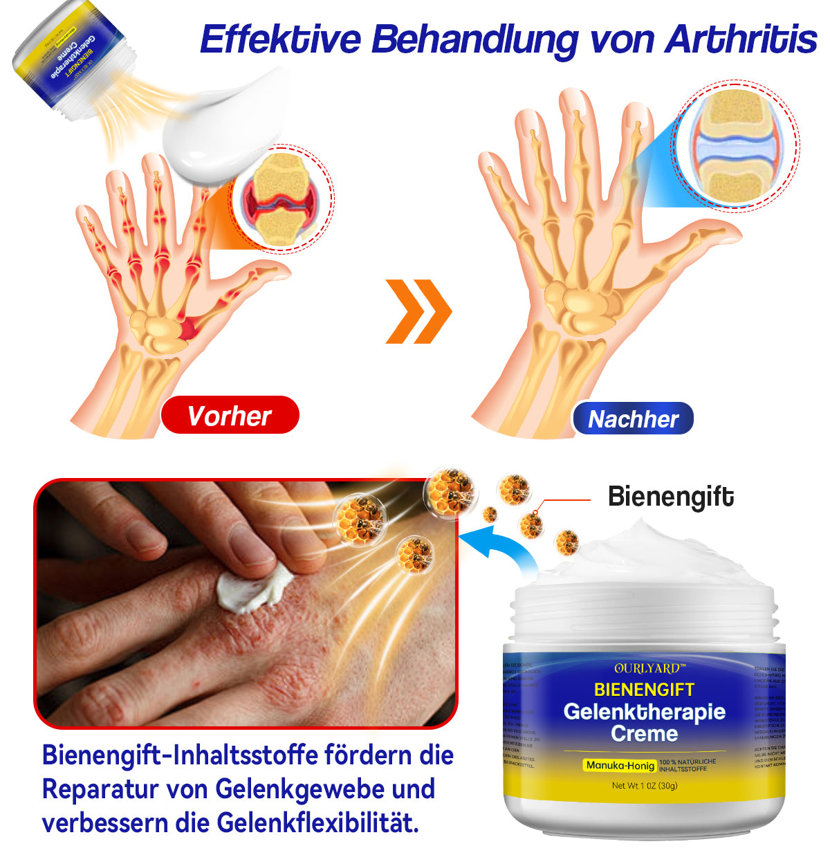 🐝🐝Ourlyard™ Bienengift-Gelenktherapie Creme: Schmerzfreie Lösung für Arthritis und knochenbedingte Probleme🌟🌟