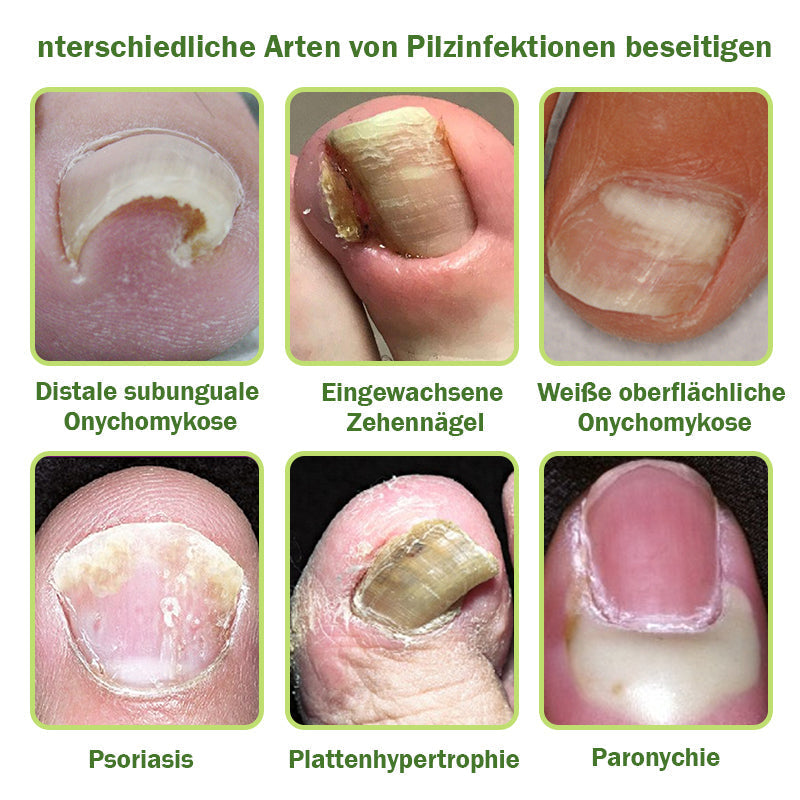 🐝Furzero™ Nagelverteidigung Bienengift-Behandlungsserum pro