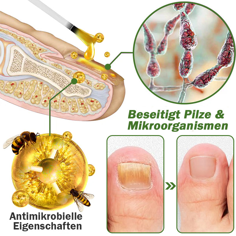 Furzero™ Nagelverteidigung Bienengift-Behandlungsserum pro