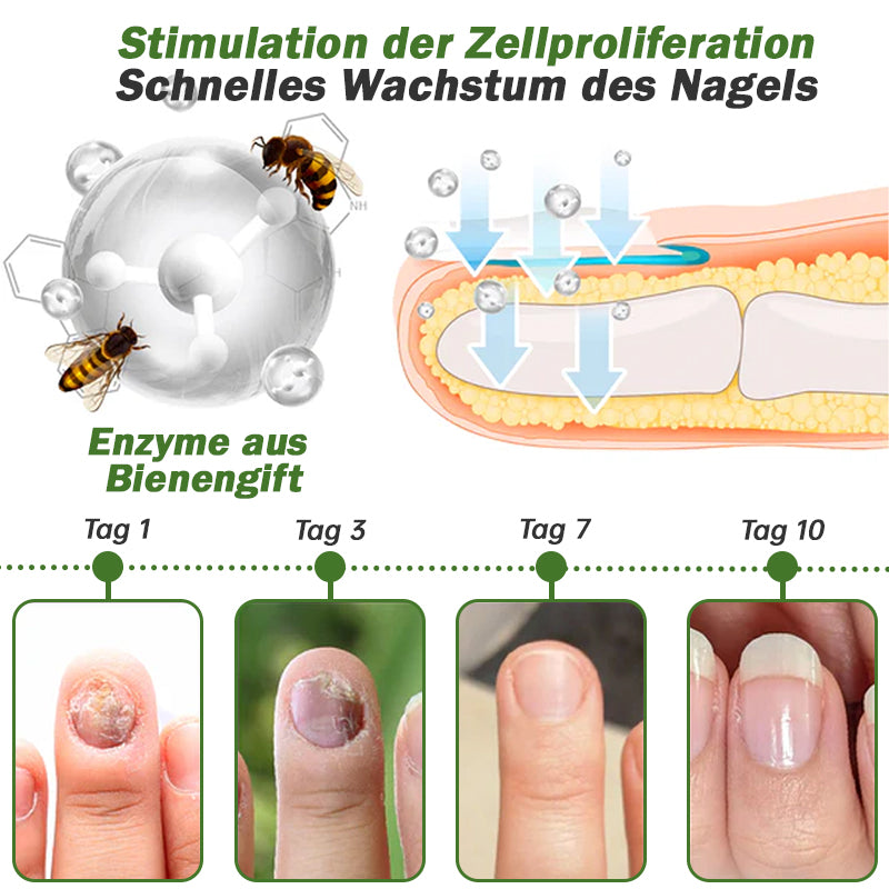 🐝🐝Furzero™ Nagelverteidigung Bienengift-Behandlungsserum pro:Behandlung verschiedener Nagelerkrankungen